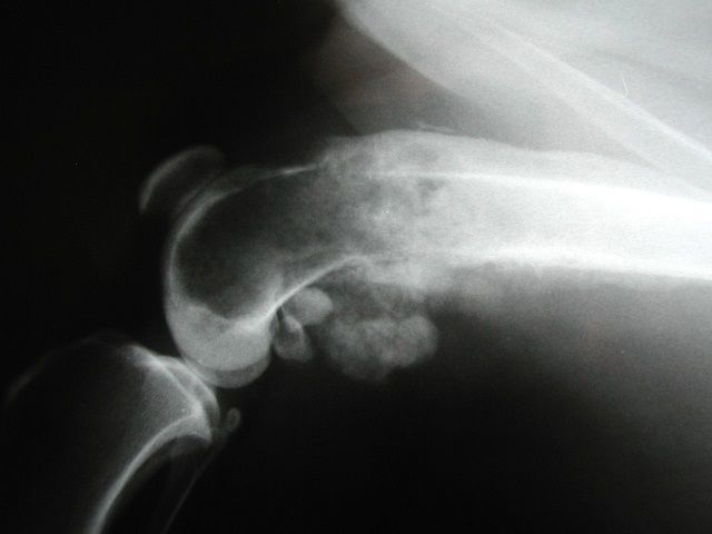 Bone cancer X-Ray in : source
